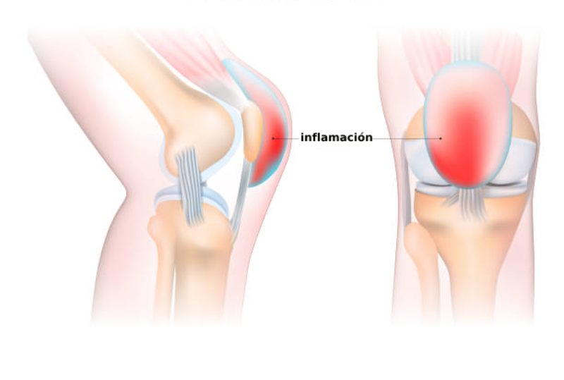 que es bursitis de rodilla 